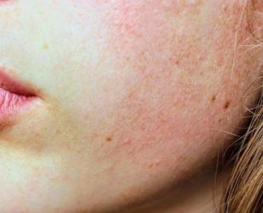 Powstrzymaj rumień wędrujący: skuteczne leczenie, szybka ulga i kroki, które możesz podjąć już dziś