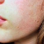 Powstrzymaj rumień wędrujący: skuteczne leczenie, szybka ulga i kroki, które możesz podjąć już dziś